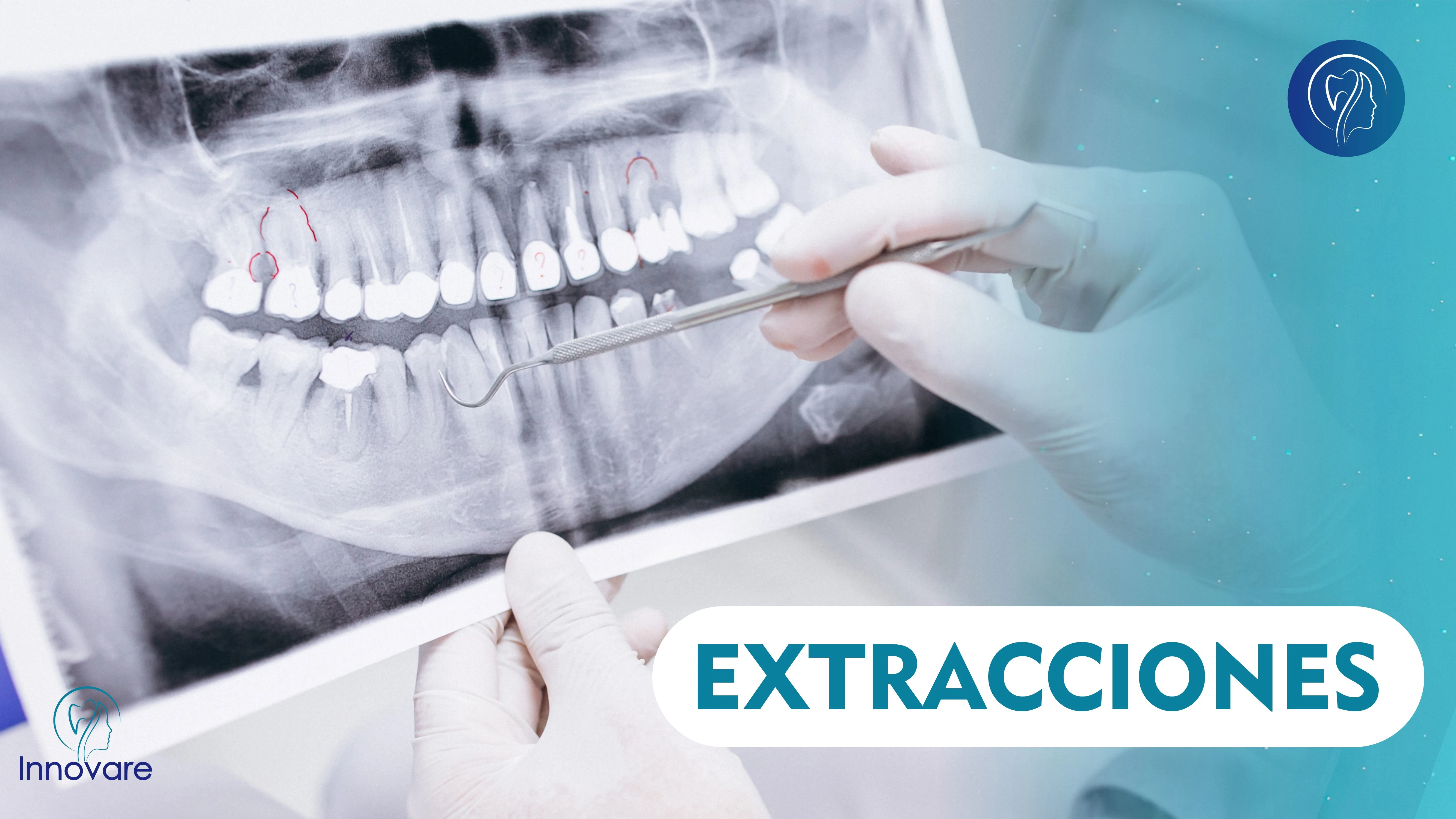 Extracciones