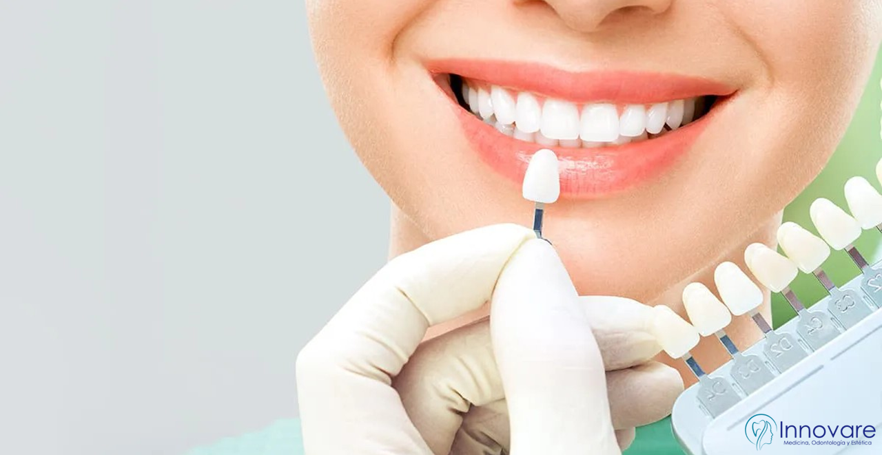 Carillas dentales: 7 errores que debes evitar antes de colocarlas