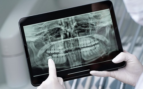 tratamiento-botox-Clinica_Innovare